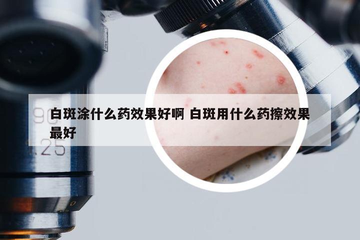 白斑涂什么药效果好啊 白斑用什么药擦效果最好