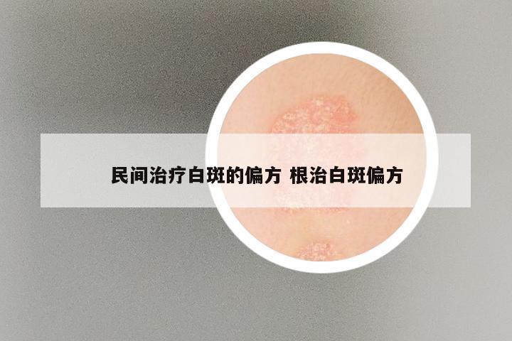 民间治疗白斑的偏方 根治白斑偏方