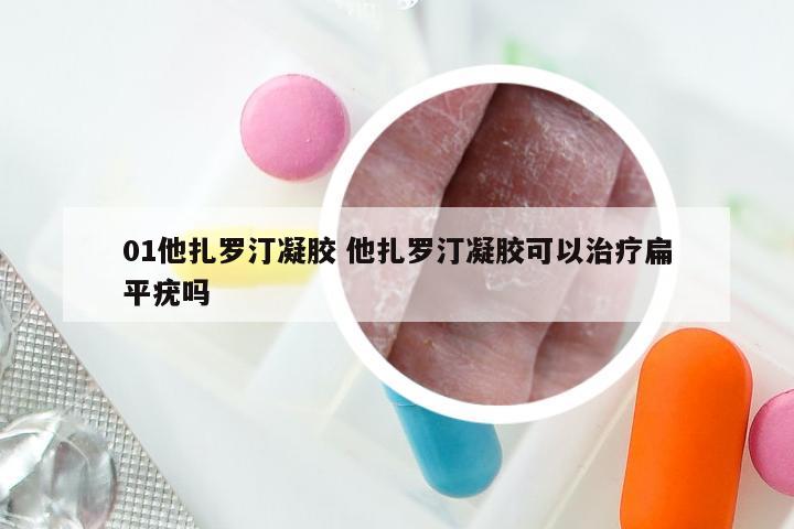 01他扎罗汀凝胶 他扎罗汀凝胶可以治疗扁平疣吗