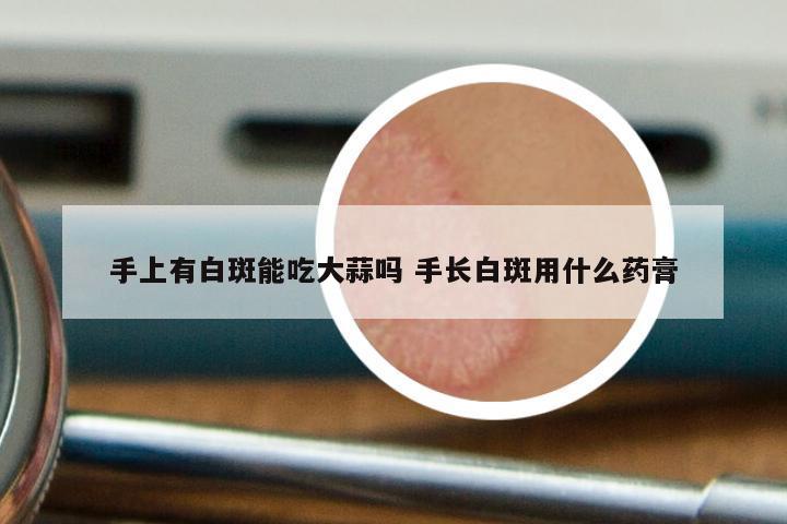 手上有白斑能吃大蒜吗 手长白斑用什么药膏