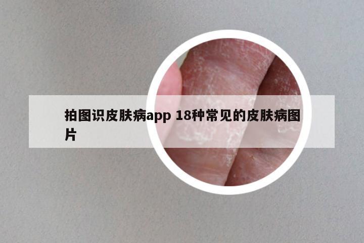 拍图识皮肤病app 18种常见的皮肤病图片