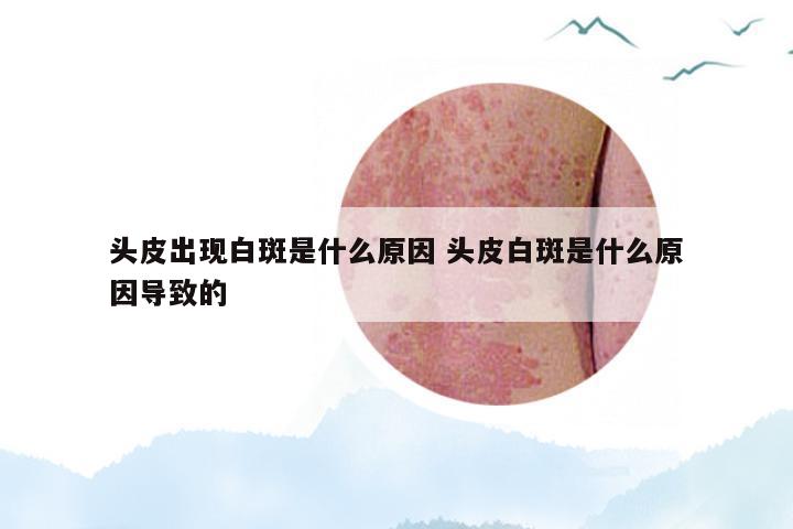 头皮出现白斑是什么原因 头皮白斑是什么原因导致的