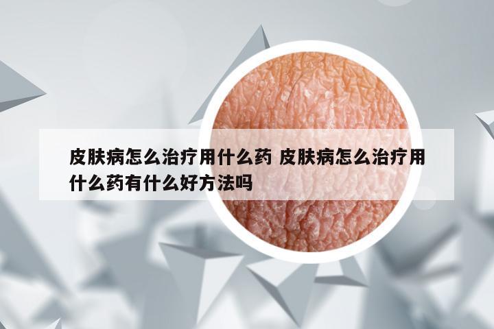 皮肤病怎么治疗用什么药 皮肤病怎么治疗用什么药有什么好方法吗