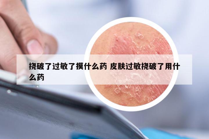 挠破了过敏了摸什么药 皮肤过敏挠破了用什么药