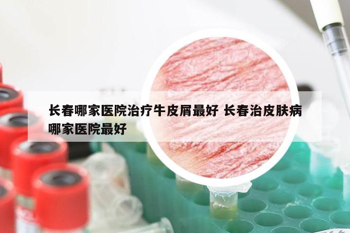 长春哪家医院治疗牛皮屑最好 长春治皮肤病哪家医院最好