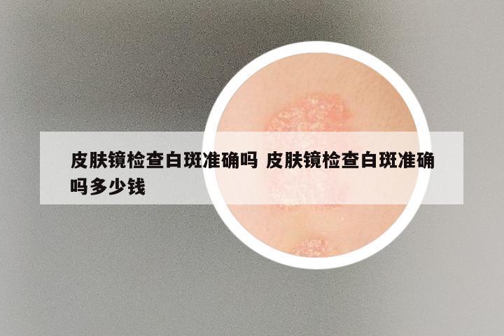 皮肤镜检查白斑准确吗 皮肤镜检查白斑准确吗多少钱