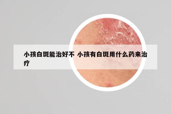 小孩白斑能治好不 小孩有白斑用什么药来治疗