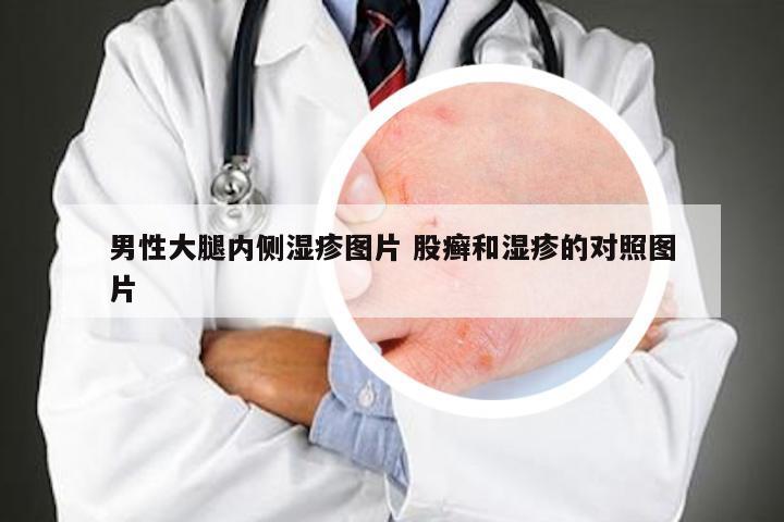 男性大腿内侧湿疹图片 股癣和湿疹的对照图片