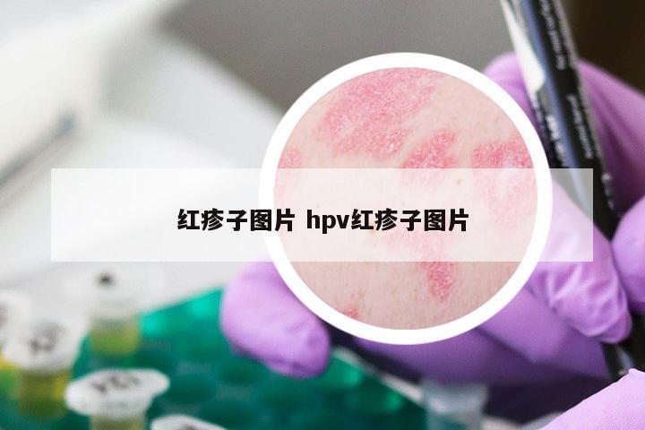 红疹子图片 hpv红疹子图片