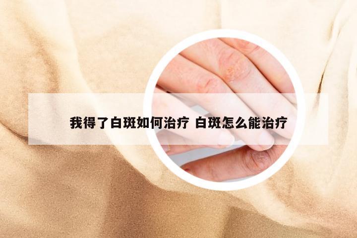 我得了白斑如何治疗 白斑怎么能治疗