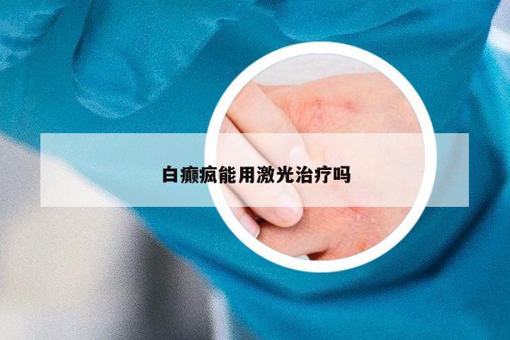 白癫疯能用激光治疗吗