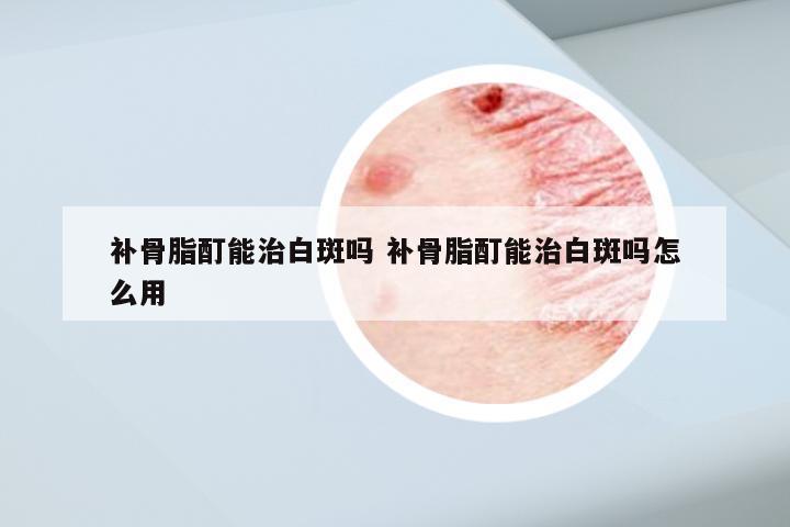 补骨脂酊能治白斑吗 补骨脂酊能治白斑吗怎么用