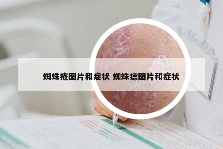 蜘蛛疮图片和症状 蜘蛛痣图片和症状