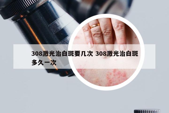 308激光治白斑要几次 308激光治白斑多久一次