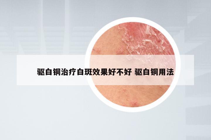 驱白铜治疗白斑效果好不好 驱白铜用法