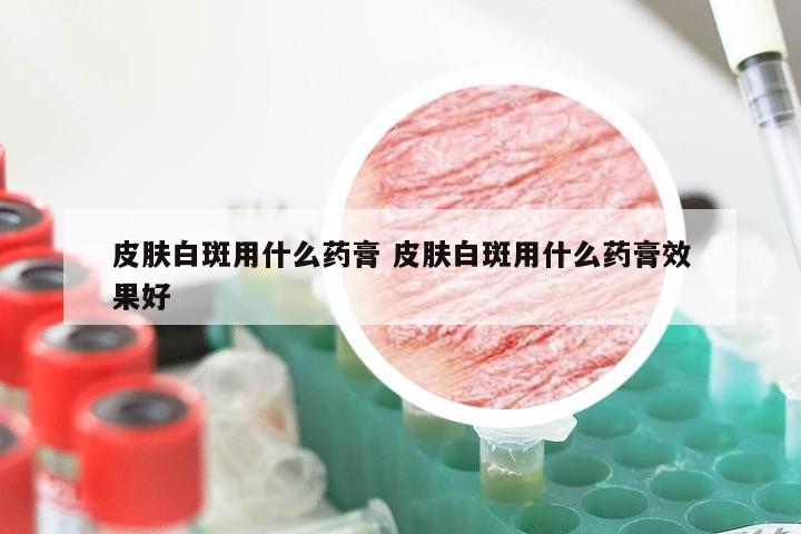 皮肤白斑用什么药膏 皮肤白斑用什么药膏效果好