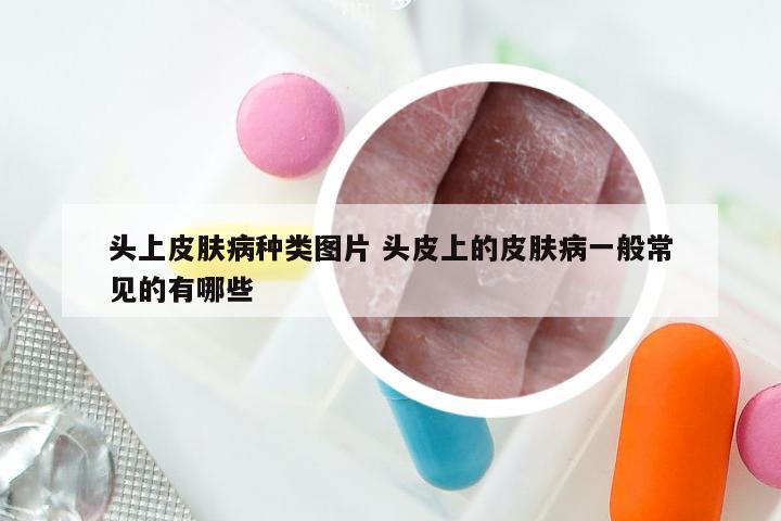 头上皮肤病种类图片 头皮上的皮肤病一般常见的有哪些