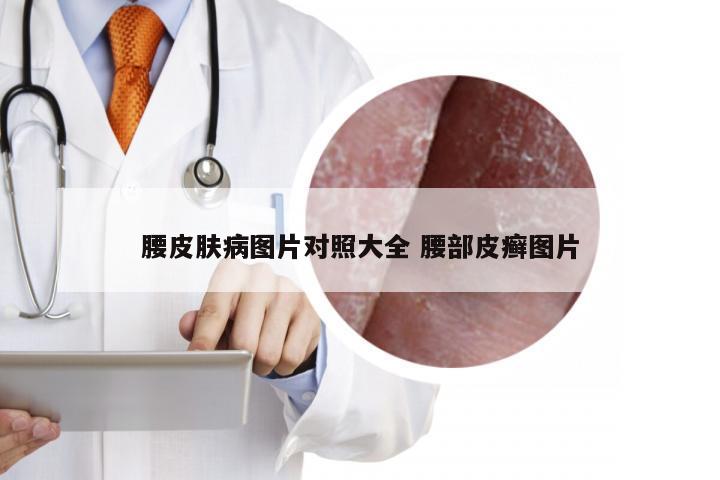 腰皮肤病图片对照大全 腰部皮癣图片