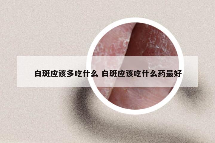 白斑应该多吃什么 白斑应该吃什么药最好