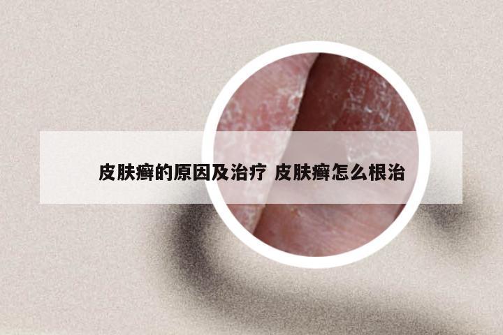 皮肤癣的原因及治疗 皮肤癣怎么根治