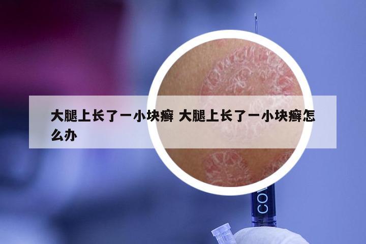 大腿上长了一小块癣 大腿上长了一小块癣怎么办