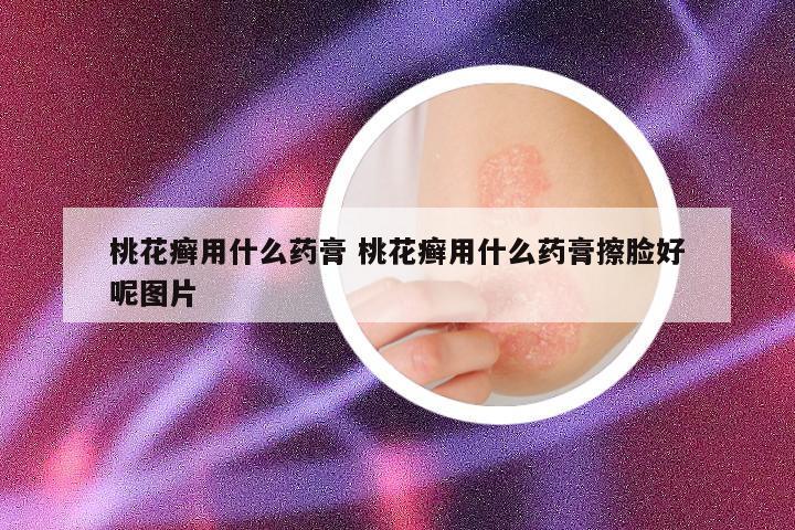 桃花癣用什么药膏 桃花癣用什么药膏擦脸好呢图片