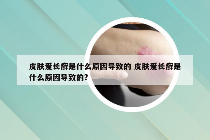 皮肤爱长癣是什么原因导致的 皮肤爱长癣是什么原因导致的?