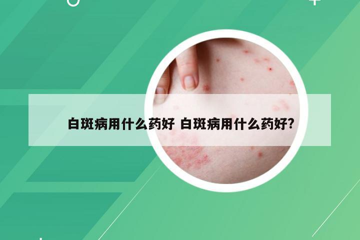 白斑病用什么药好 白斑病用什么药好?