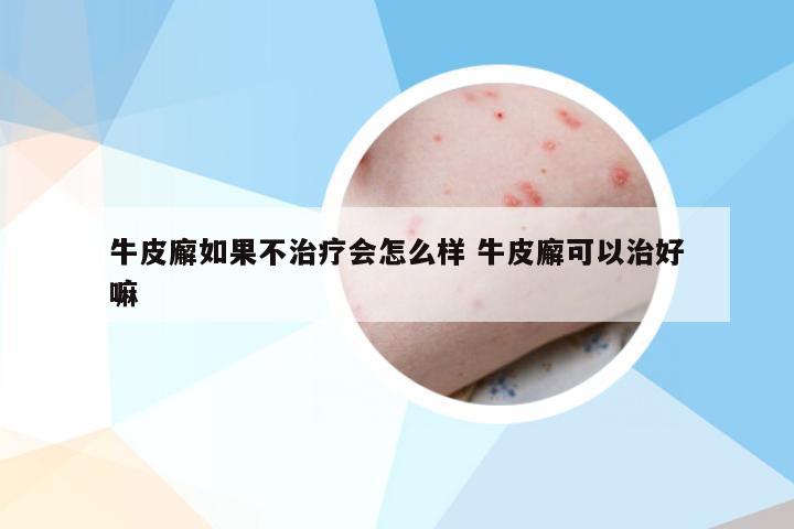 牛皮廨如果不治疗会怎么样 牛皮廨可以治好嘛