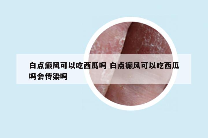 白点癫风可以吃西瓜吗 白点癫风可以吃西瓜吗会传染吗