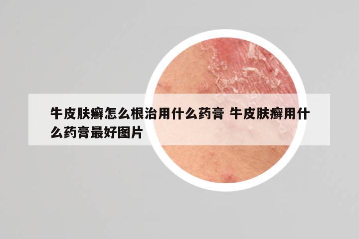 牛皮肤癣怎么根治用什么药膏 牛皮肤癣用什么药膏最好图片