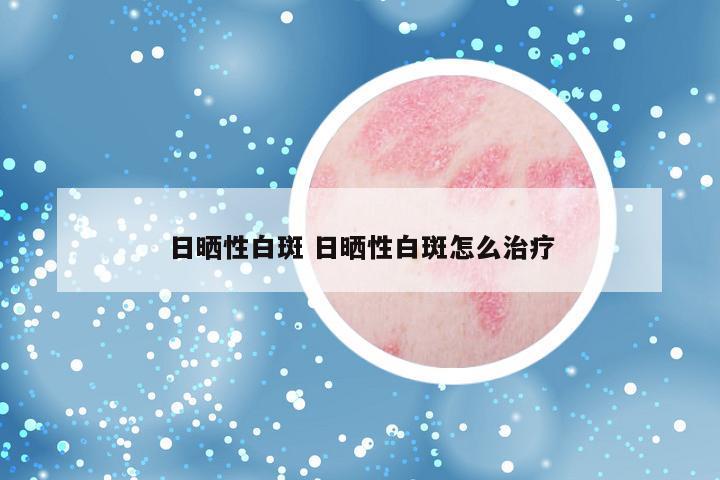 日晒性白斑 日晒性白斑怎么治疗