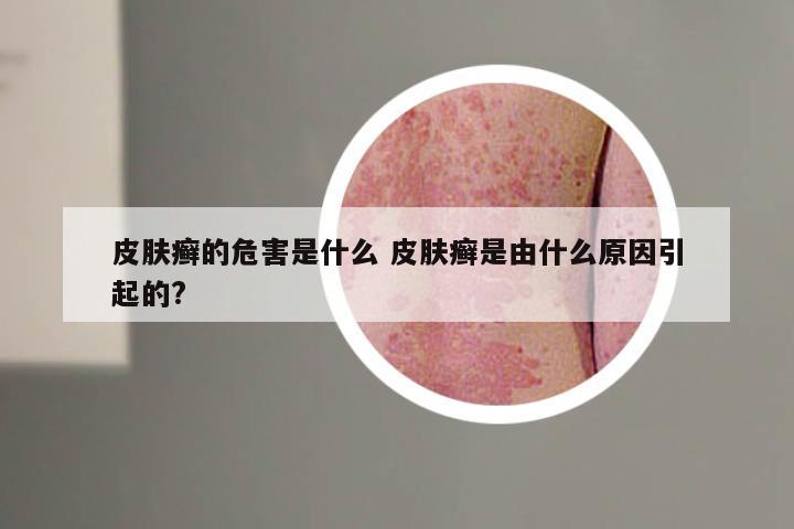 皮肤癣的危害是什么 皮肤癣是由什么原因引起的?