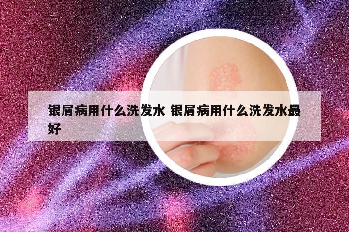 银屑病用什么洗发水 银屑病用什么洗发水最好