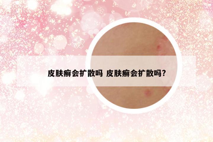 皮肤癣会扩散吗 皮肤癣会扩散吗?