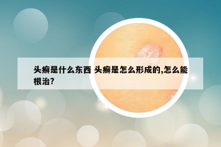 头癣是什么东西 头癣是怎么形成的,怎么能根治?