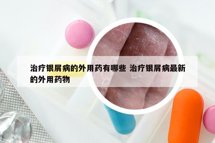 治疗银屑病的外用药有哪些 治疗银屑病最新的外用药物