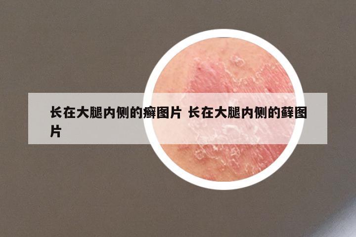 长在大腿内侧的癣图片 长在大腿内侧的藓图片