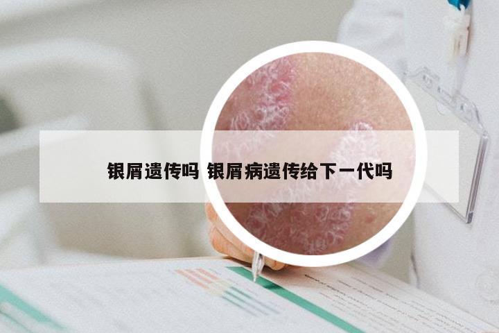 银屑遗传吗 银屑病遗传给下一代吗