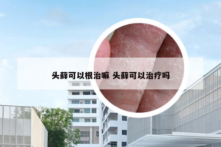 头藓可以根治嘛 头藓可以治疗吗