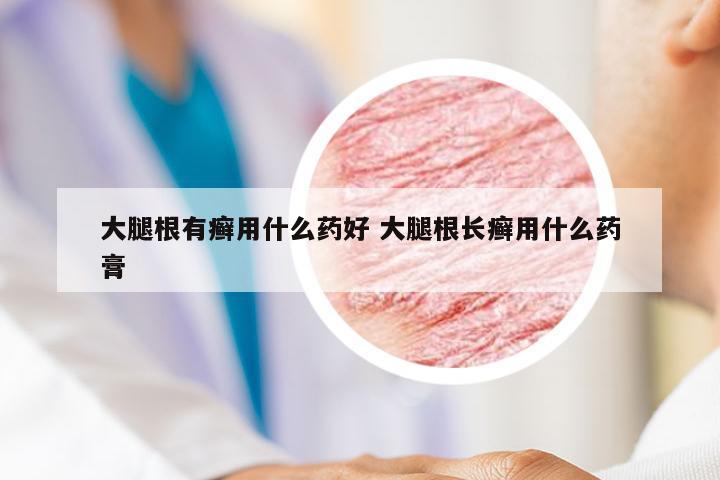 大腿根有癣用什么药好 大腿根长癣用什么药膏