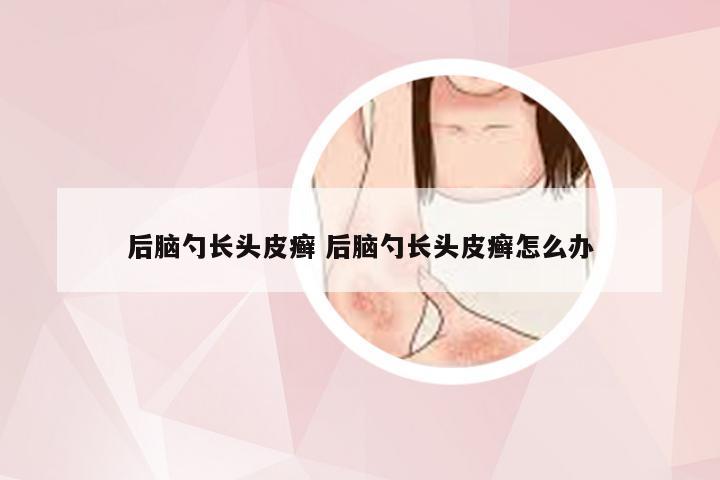 后脑勺长头皮癣 后脑勺长头皮癣怎么办