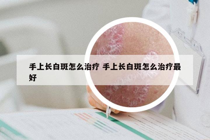 手上长白斑怎么治疗 手上长白斑怎么治疗最好