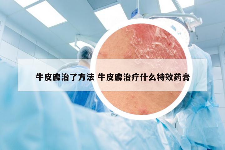 牛皮廨治了方法 牛皮廨治疗什么特效药膏