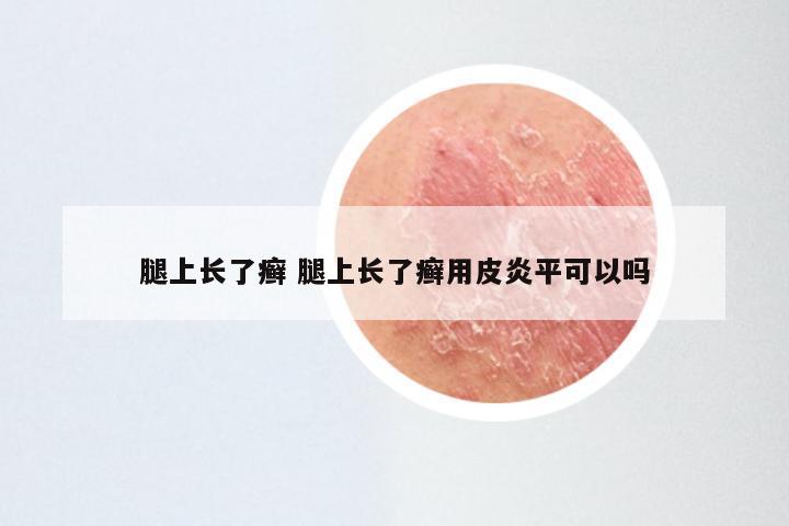 腿上长了癣 腿上长了癣用皮炎平可以吗