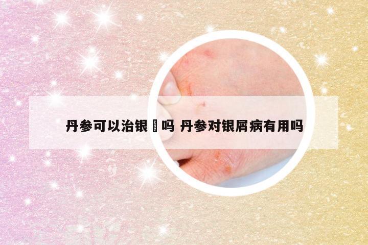 丹参可以治银痟吗 丹参对银屑病有用吗