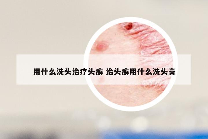 用什么洗头治疗头癣 治头癣用什么洗头膏