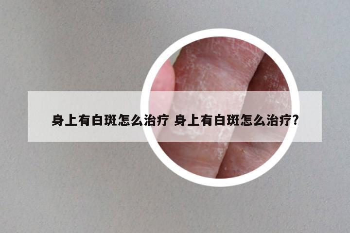 身上有白斑怎么治疗 身上有白斑怎么治疗?