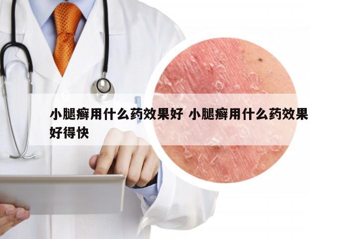 小腿癣用什么药效果好 小腿癣用什么药效果好得快