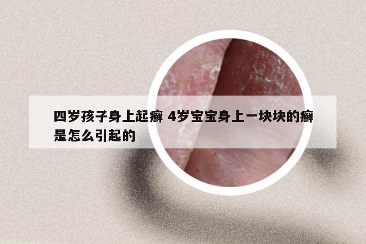 四岁孩子身上起癣 4岁宝宝身上一块块的癣是怎么引起的